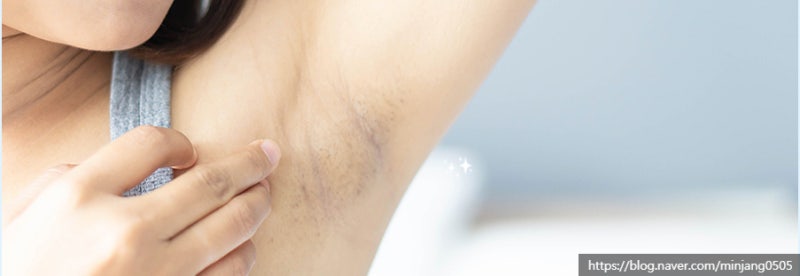 겨털뽑으면 암내 및 모낭염 생기는 이유 사진 7
