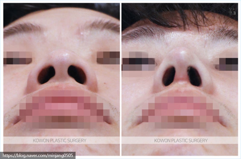 코끝연골묶기로 복코를 개선한 복코수술전후 사진 5