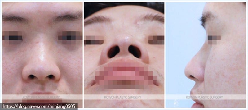 코끝연골묶기로 복코를 개선한 복코수술전후 사진 2