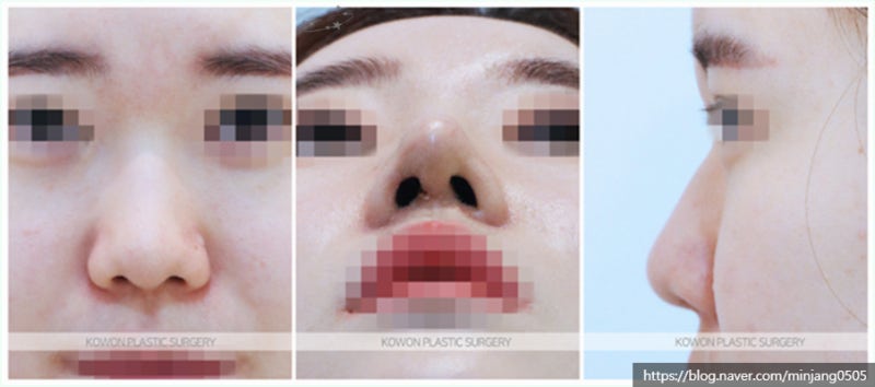 코재수술유명한곳 코끝 정리 하이코실제거