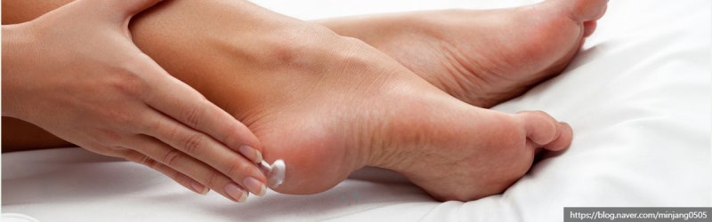 발뒤꿈치갈라짐 원인 및 관리 방법 사진 13