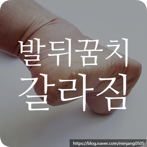 발뒤꿈치갈라짐 원인 및 관리 방법