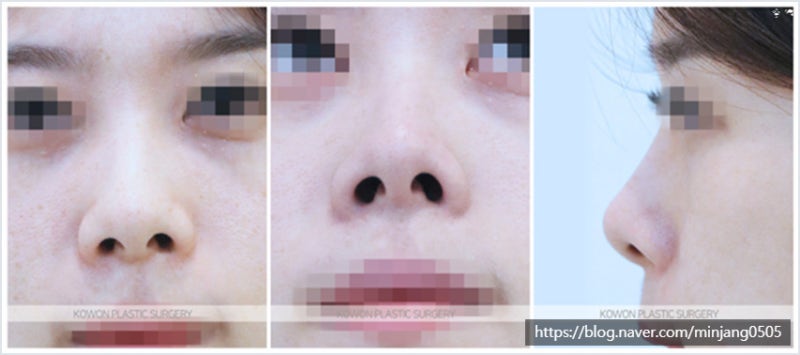 콧구멍비대칭 교정 및 코끝연장 동시에 해결