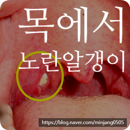 목에서노란알갱이 입냄새 편도결석증상