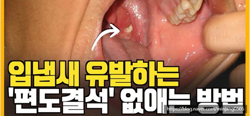 목에서노란알갱이 입냄새 편도결석증상 사진 3
