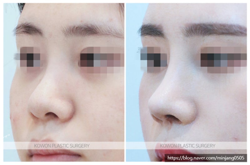 마늘코 비중격연장 코성형 및 코필러녹이기