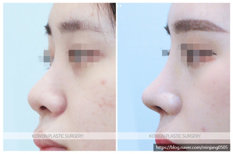 마늘코 비중격연장 코성형 및 코필러녹이기 사진 7