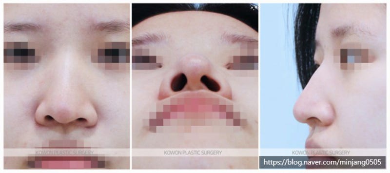 삐뚤어진코 절골통한 여자매부리코 개선사례 사진 2