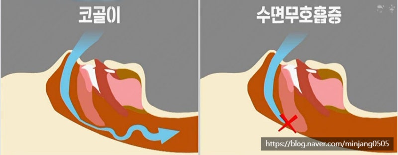 입벌리고자면 안되는이유 구강호흡 얼굴변형 사진 7