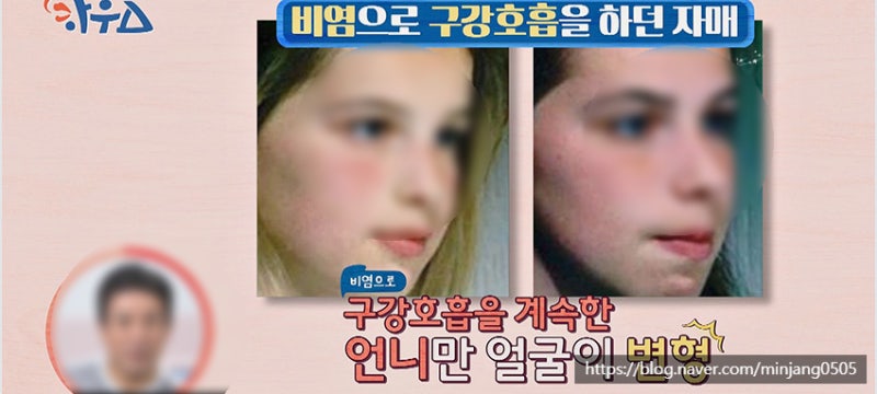 입벌리고자면 안되는이유 구강호흡 얼굴변형 사진 11