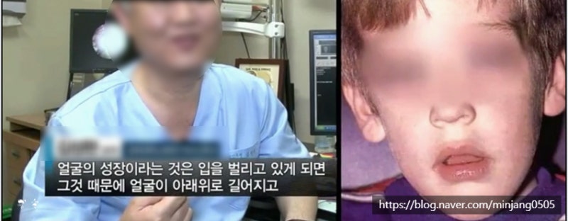 입벌리고자면 안되는이유 구강호흡 얼굴변형 사진 10