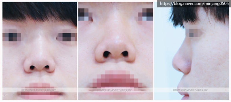 남자직선코 짧은코끝 낮은코성형후기 사진 2