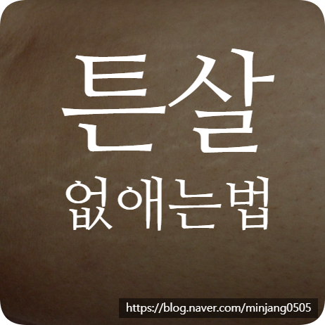 튼살없애는법 임산부튼살 홈케어 레이저