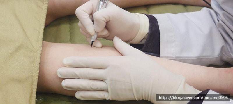 튼살없애는법 임산부튼살 홈케어 레이저 사진 8