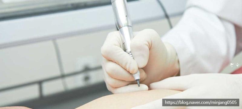 튼살없애는법 임산부튼살 홈케어 레이저 사진 7