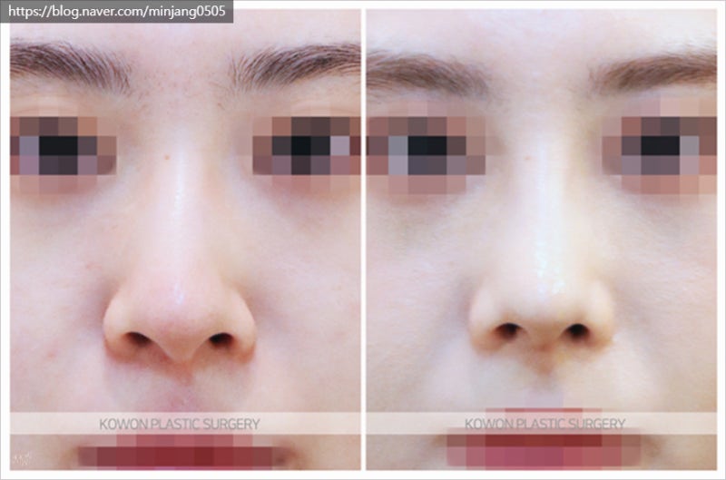 코뼈휨 휜코성형 및 코끝연골묶기후기 사진 8