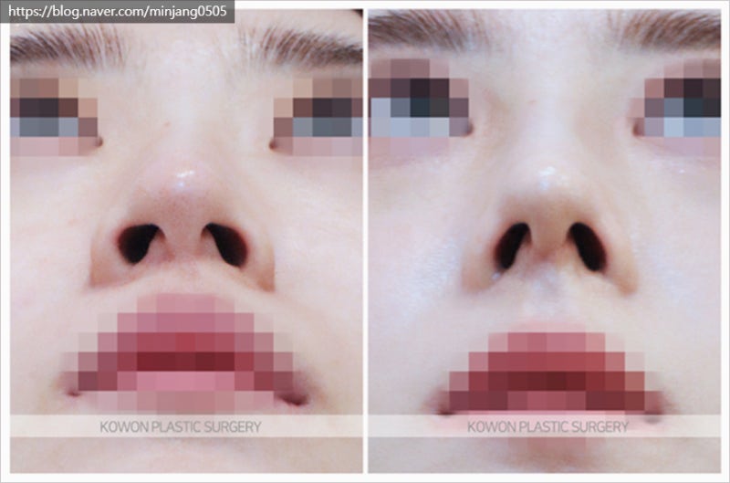 코뼈휨 휜코성형 및 코끝연골묶기후기 사진 7