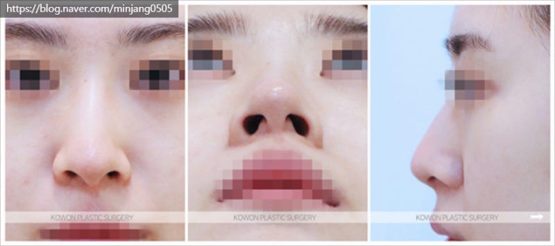 코뼈휨 휜코성형 및 코끝연골묶기후기 사진 2