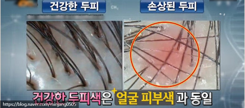 머리카락끊김 증상 및 음식 보습 관리법 사진 11