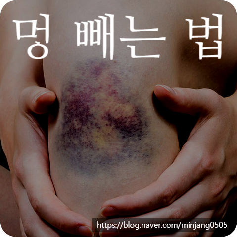 멍빼는법 색깔 연고 및 멍잘드는이유
