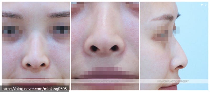 코높아지는법 쁘띠시술 실 제거 및 코짝짝이 교정 사진 2
