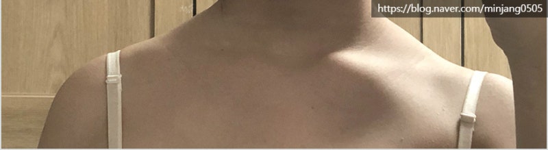 승모근없애는법 및 생활습관 거북목 원인 사진 8