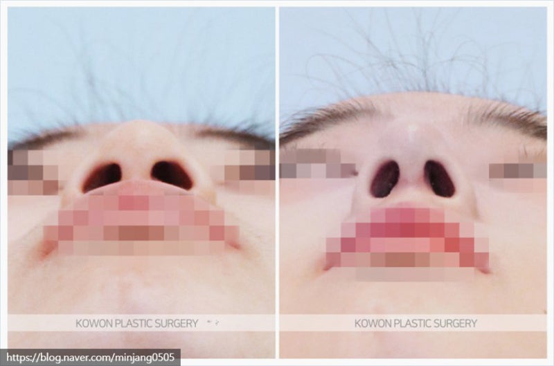 코짧아지는법 통한 뚜렷한이목구비 개선 및 코끝성형후기