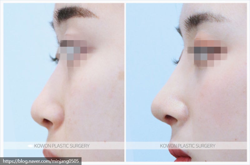 코짧아지는법 통한 뚜렷한이목구비 개선 및 코끝성형후기 사진 8