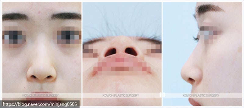코짧아지는법 통한 뚜렷한이목구비 개선 및 코끝성형후기 사진 2