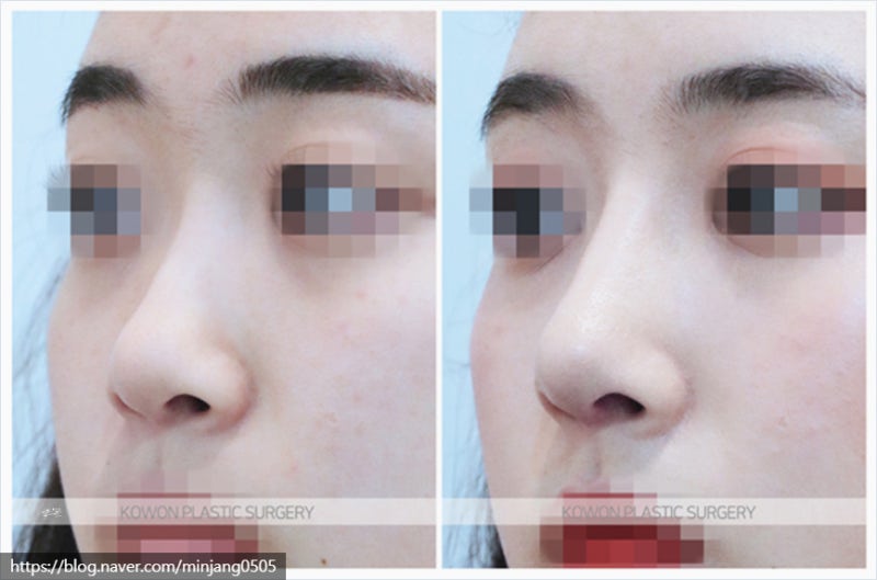 코짧아지는법 통한 뚜렷한이목구비 개선 및 코끝성형후기 사진 7
