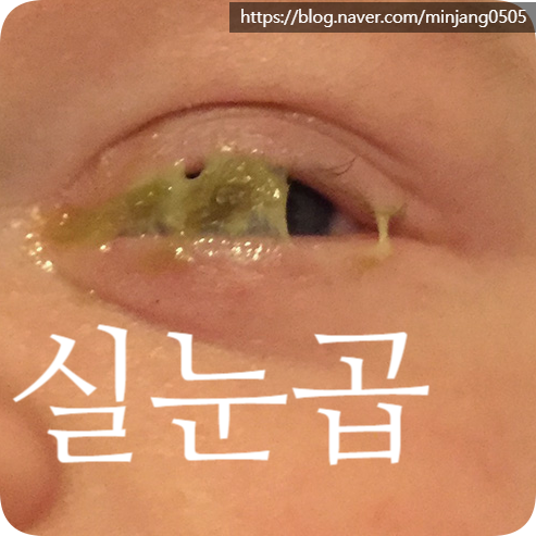 실눈곱 원인 증상 및 안구건조증 예방법