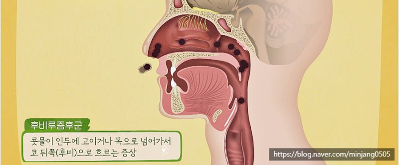 입천장간지러움 원인 후비루증후군 사진 6