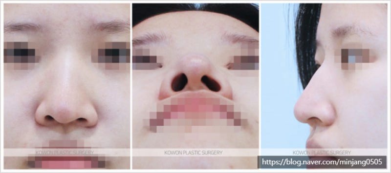 콧구멍 축소수술 동시에 매부리 절골 및 코끝내리기 사진 2