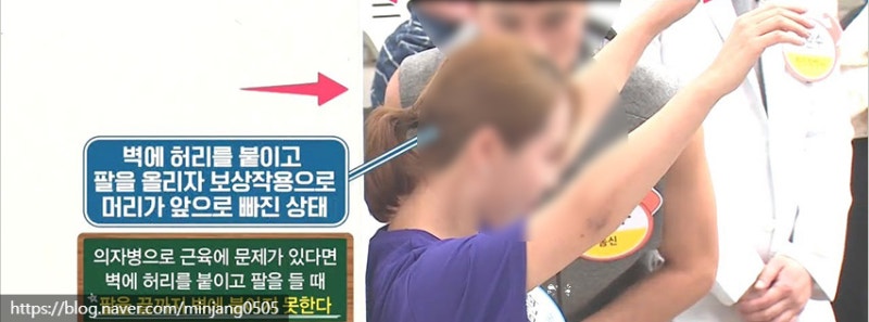 의자병 원인 및 척추측만증 하지정맥류 위험성 사진 10