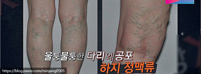 의자병 원인 및 척추측만증 하지정맥류 위험성 사진 8