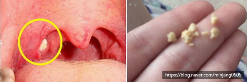 침삼킬때이물감 목통증원인 및 해결방법 사진 4