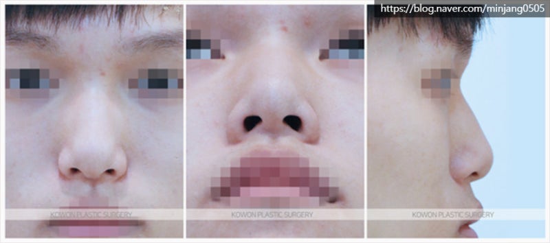 남자코끝성형 콧등절골 잘하는곳 신사역코성형외과 사진 2