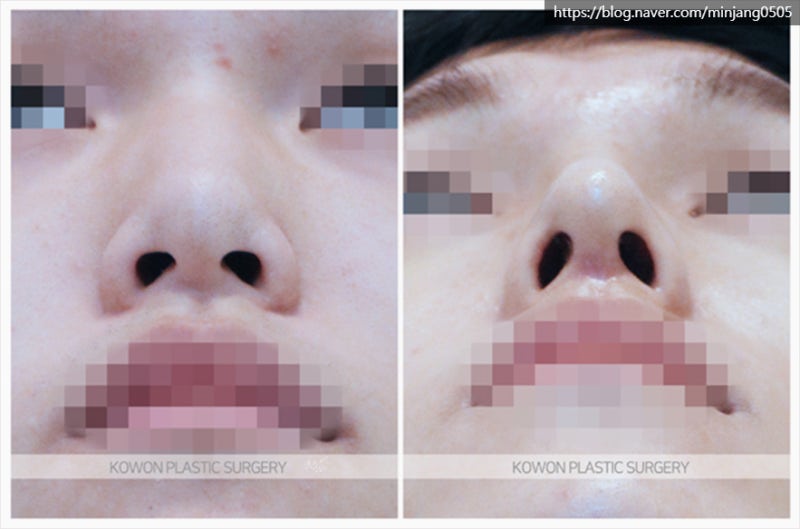 남자코끝성형 콧등절골 잘하는곳 신사역코성형외과 사진 6