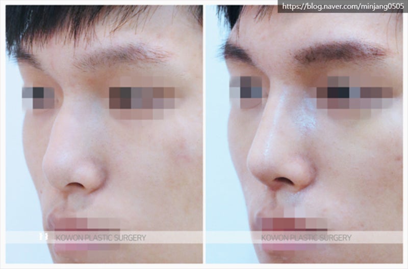남자코끝성형 콧등절골 잘하는곳 신사역코성형외과 사진 7