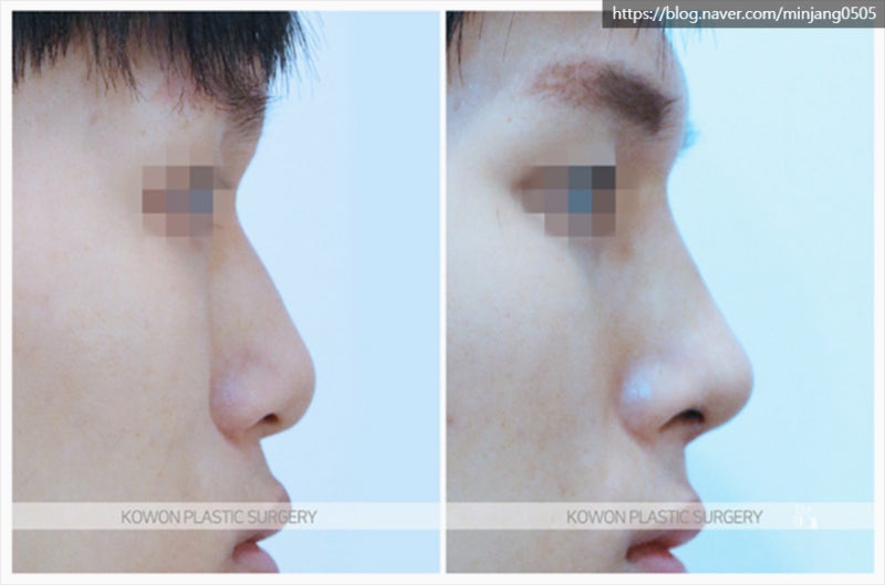남자코끝성형 콧등절골 잘하는곳 신사역코성형외과 사진 8