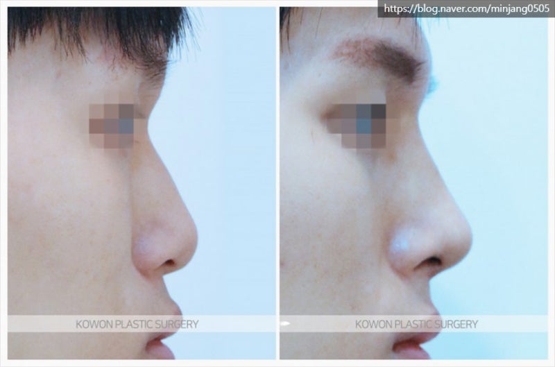 남자코끝성형 콧등절골 잘하는곳 신사역코성형외과
