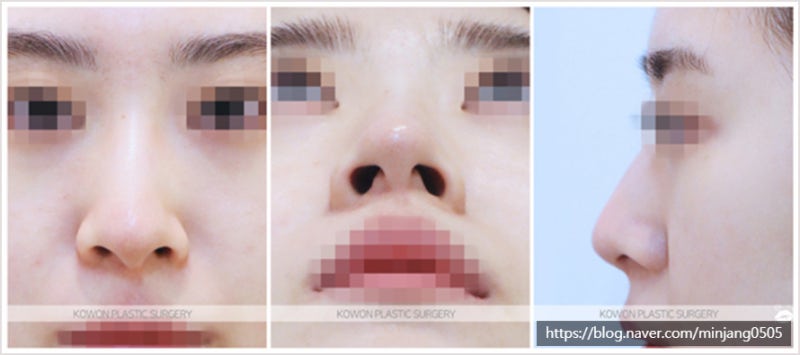 무보형물코수술 복코개선 및 휜코교정비용 사진 2