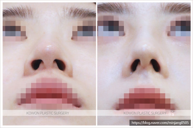 무보형물코수술 복코개선 및 휜코교정비용 사진 7