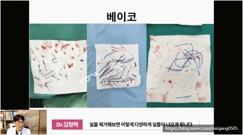 코재수술유명한곳 염증 걱정없는 안전한 코실제거 사진 6