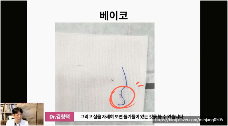 코재수술유명한곳 염증 걱정없는 안전한 코실제거 사진 9