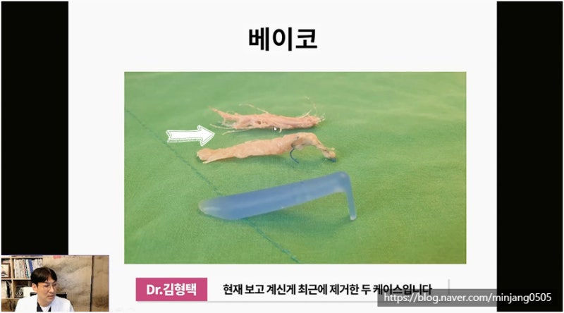 코재수술유명한곳 염증 걱정없는 안전한 코실제거 사진 10