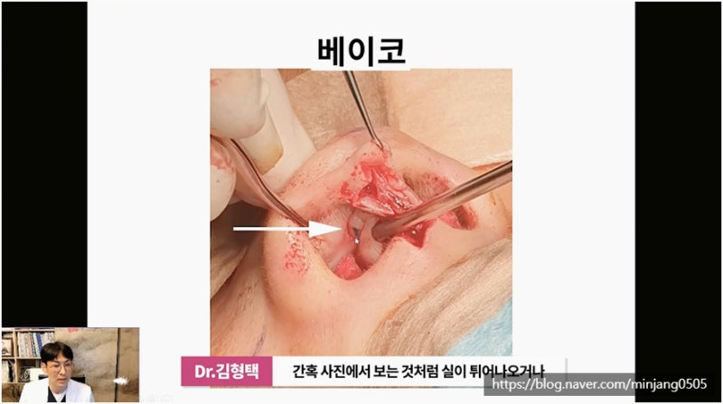 코재수술유명한곳 염증 걱정없는 안전한 코실제거 사진 5