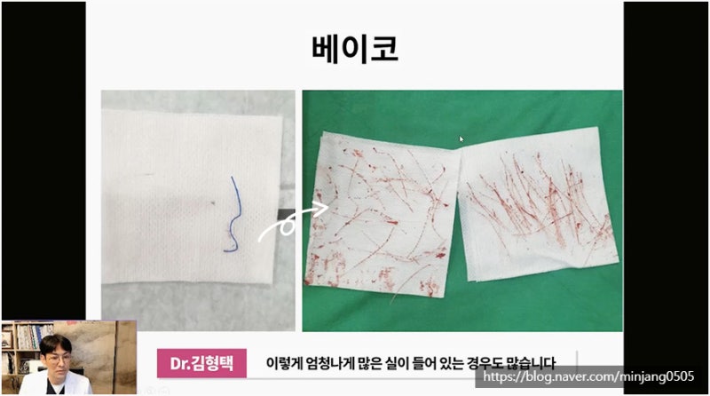 코재수술유명한곳 염증 걱정없는 안전한 코실제거 사진 7