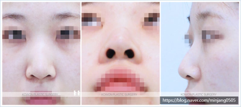 켈로이드수술 흉터없는 코성형 입툭튀교정 효과까지 사진 2