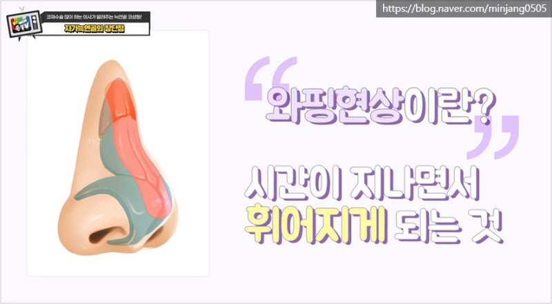 압구정코수술 유명한곳 자가늑연골 장점 및 단점 사진 13